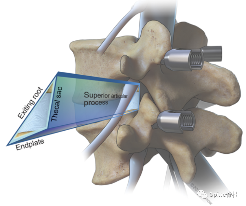“安全三角”真的安全吗?——脊柱微创里的