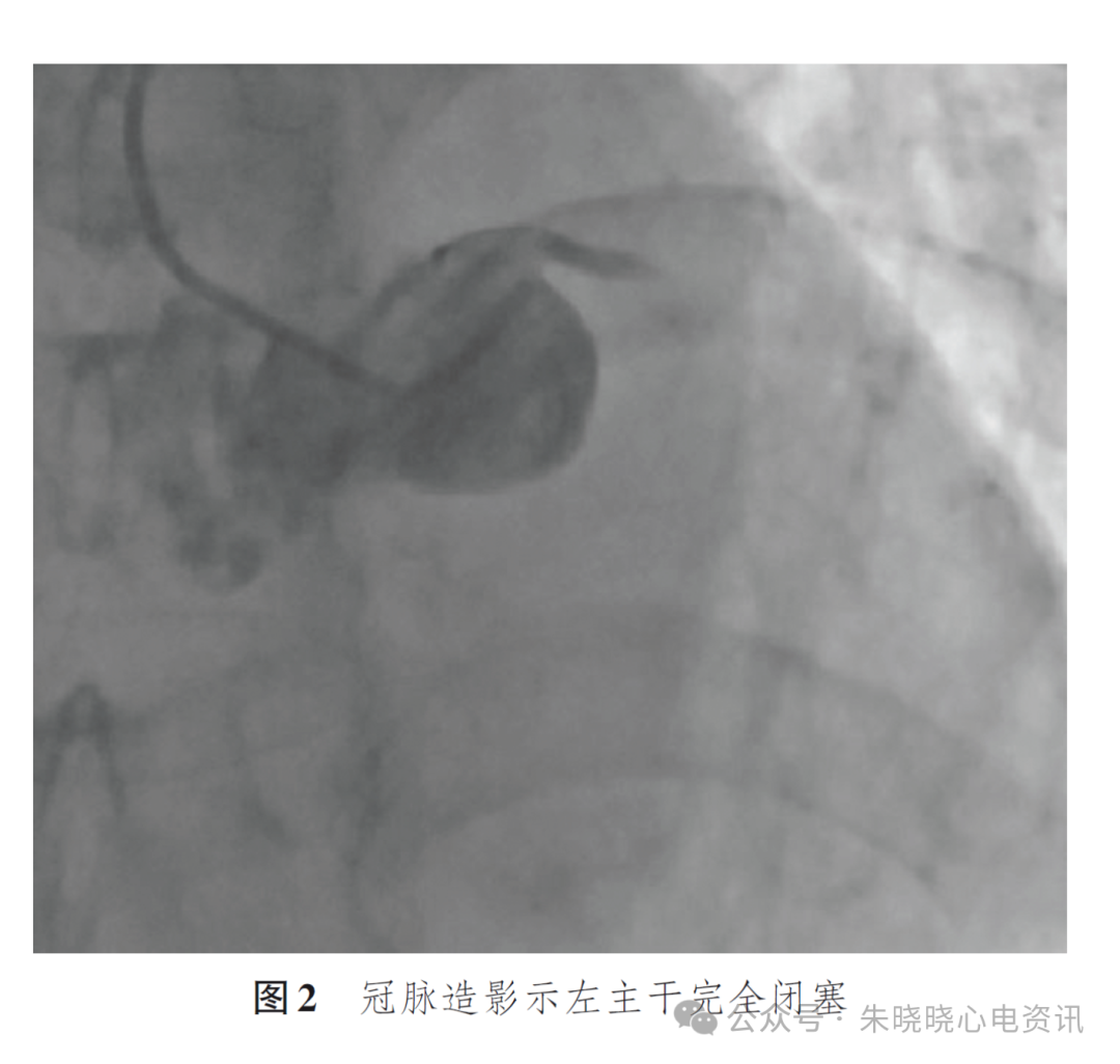 左主干急性完全闭塞的心电图特征