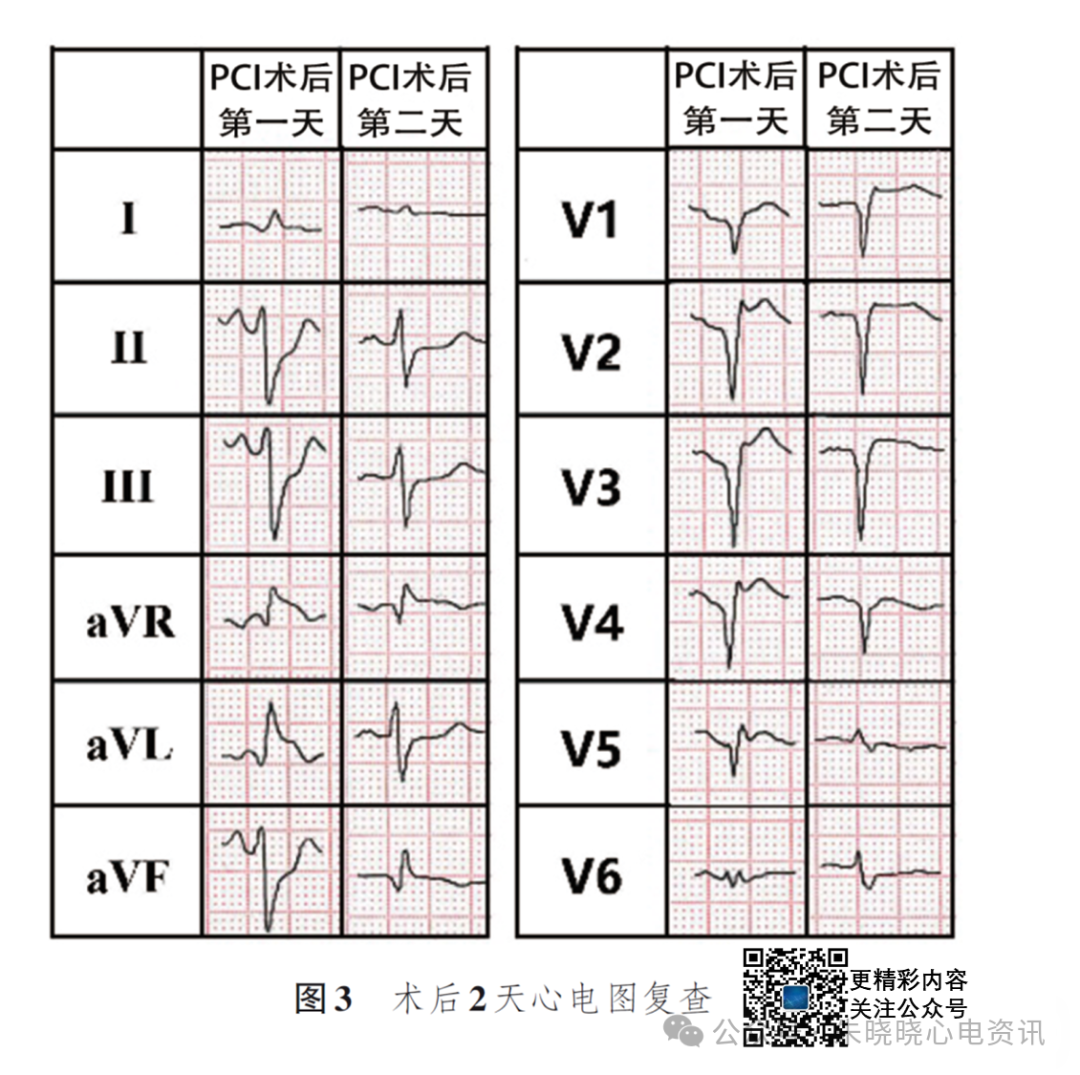 左主干急性完全闭塞的心电图特征