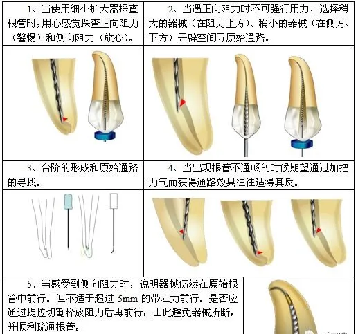 根管治疗标准步骤和细节把握