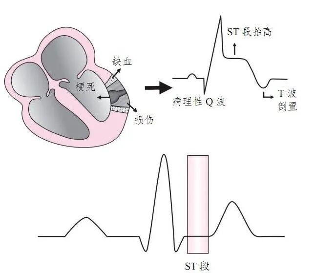心肌梗死的心电图诊断标准、定位及演变
