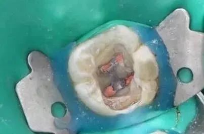 根管充填试尖怎么做？从卡爆感到操作，一篇讲透关键步