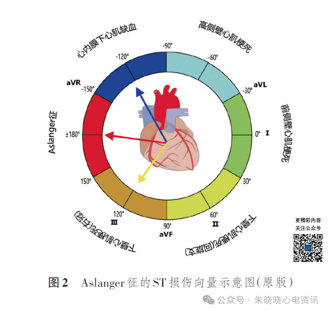 解读急性下壁心肌梗死的Aslanger征