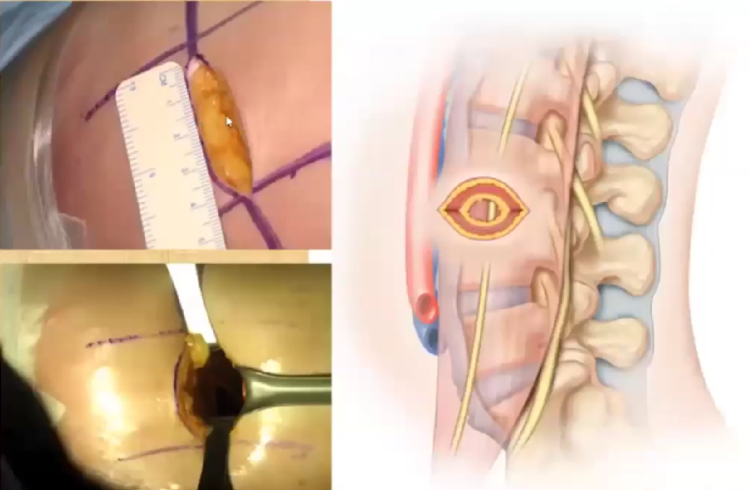 《手术精讲》|