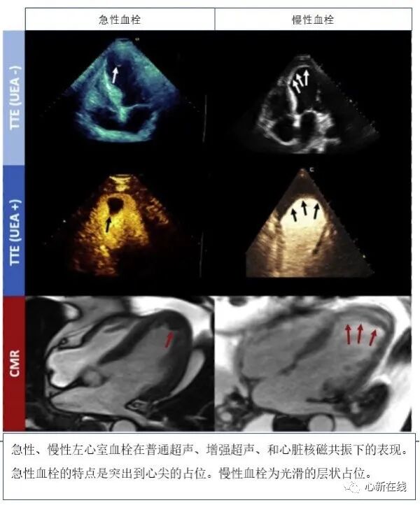 急性心肌梗死后左心室血栓的管理