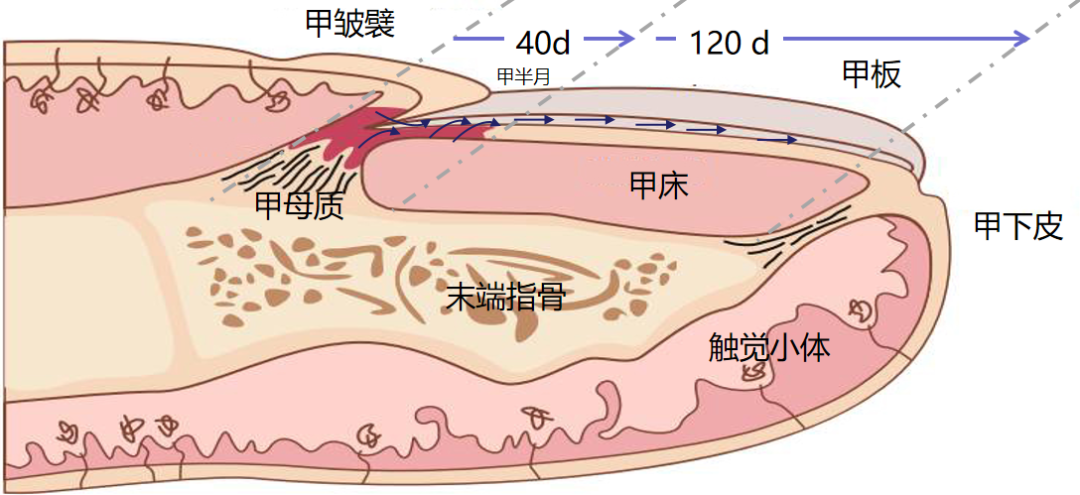 嵌甲性甲沟炎的诊治技巧，教科书没有传授的秘密！