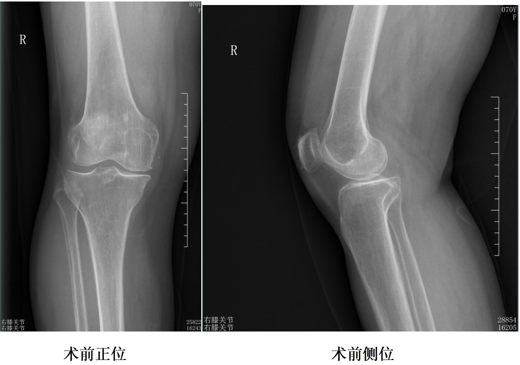 【手术视频】第四期：固定平台单髁置换术(SIGMA