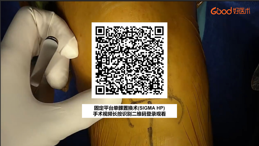 【手术视频】第四期：固定平台单髁置换术(SIGMA