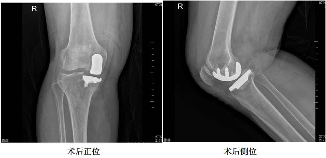 【手术视频】第四期：固定平台单髁置换术(SIGMA