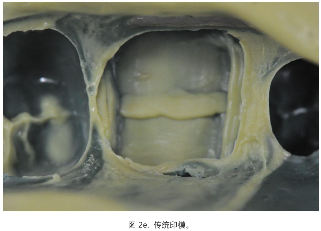 【病例分享】龈壁抬升的研究