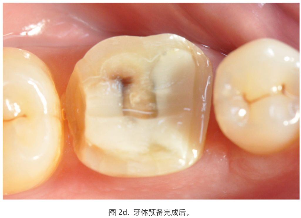 【病例分享】龈壁抬升的研究