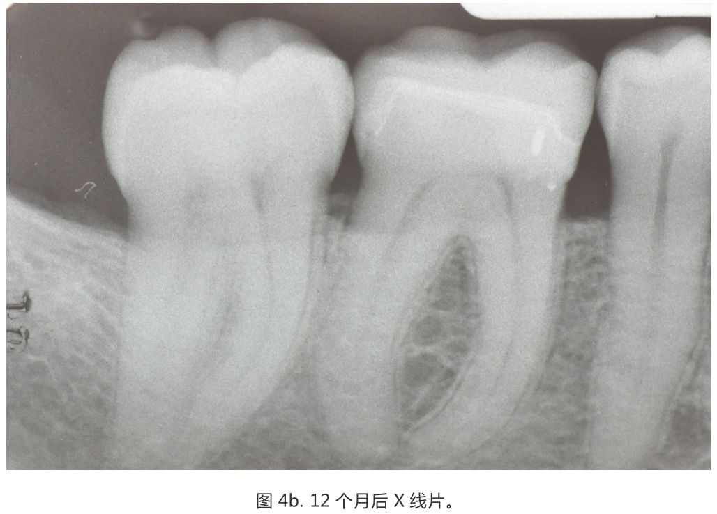 【病例分享】龈壁抬升的研究