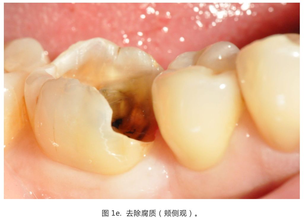 【病例分享】龈壁抬升的研究