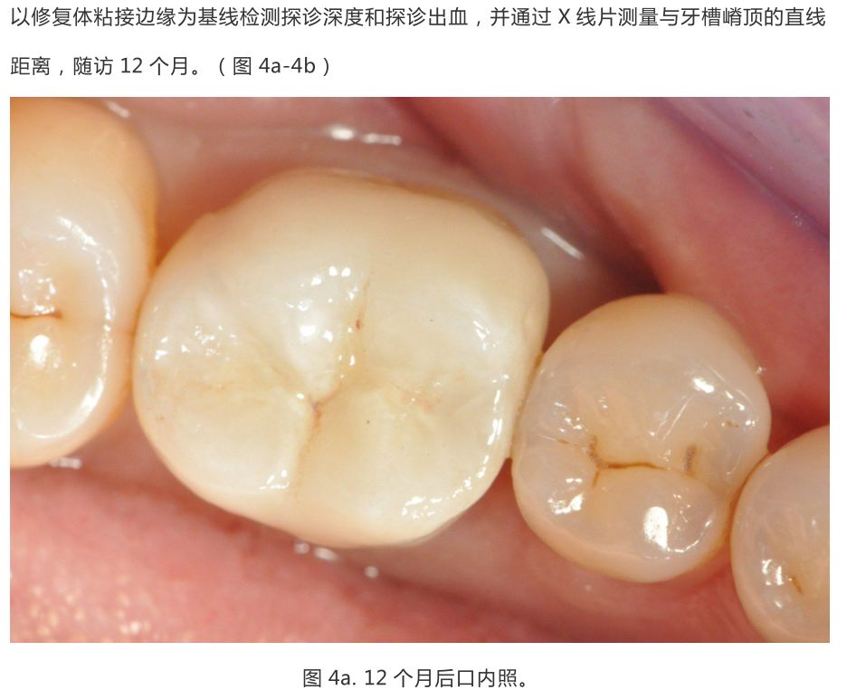 【病例分享】龈壁抬升的研究