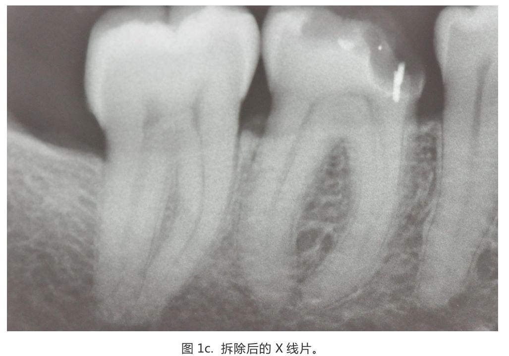【病例分享】龈壁抬升的研究