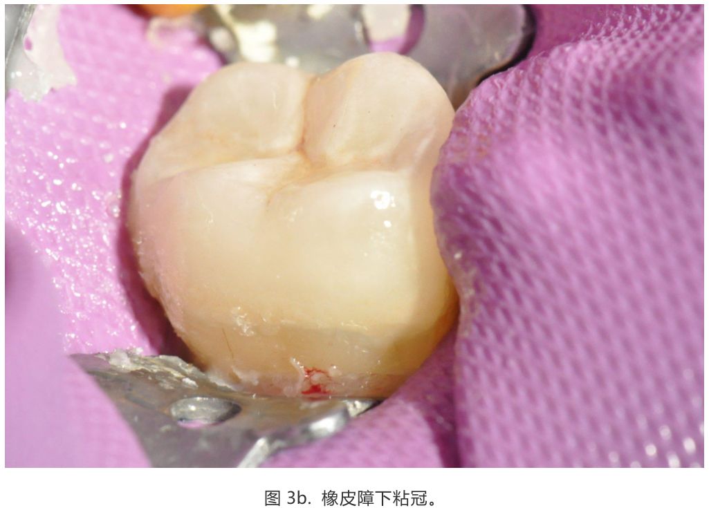 【病例分享】龈壁抬升的研究