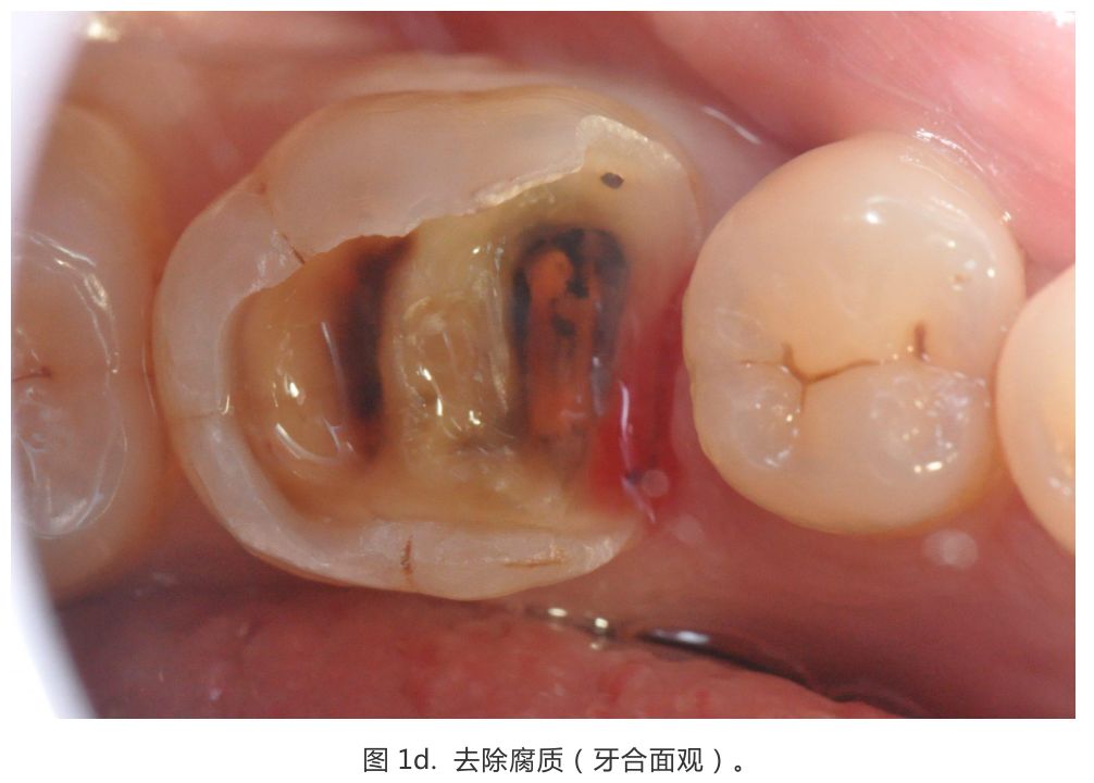 【病例分享】龈壁抬升的研究