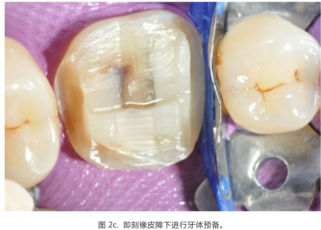【病例分享】龈壁抬升的研究