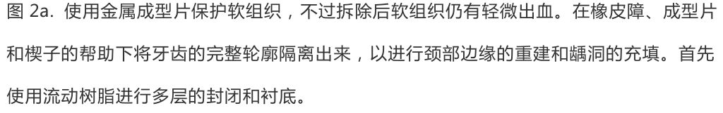 【病例分享】龈壁抬升的研究