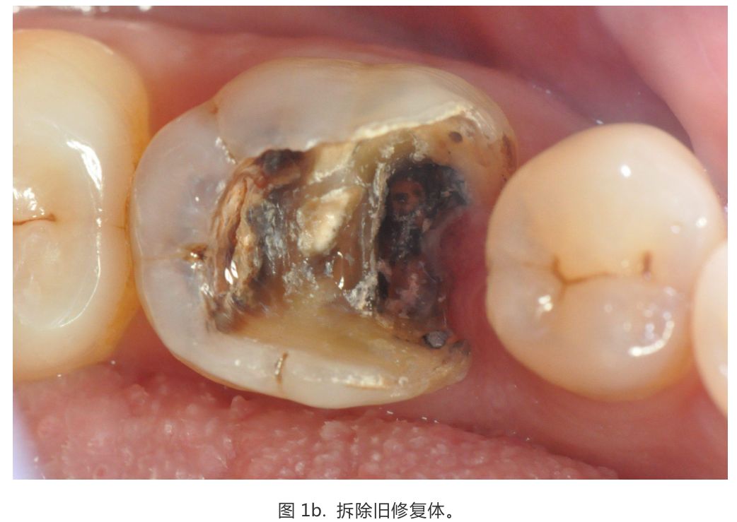 【病例分享】龈壁抬升的研究