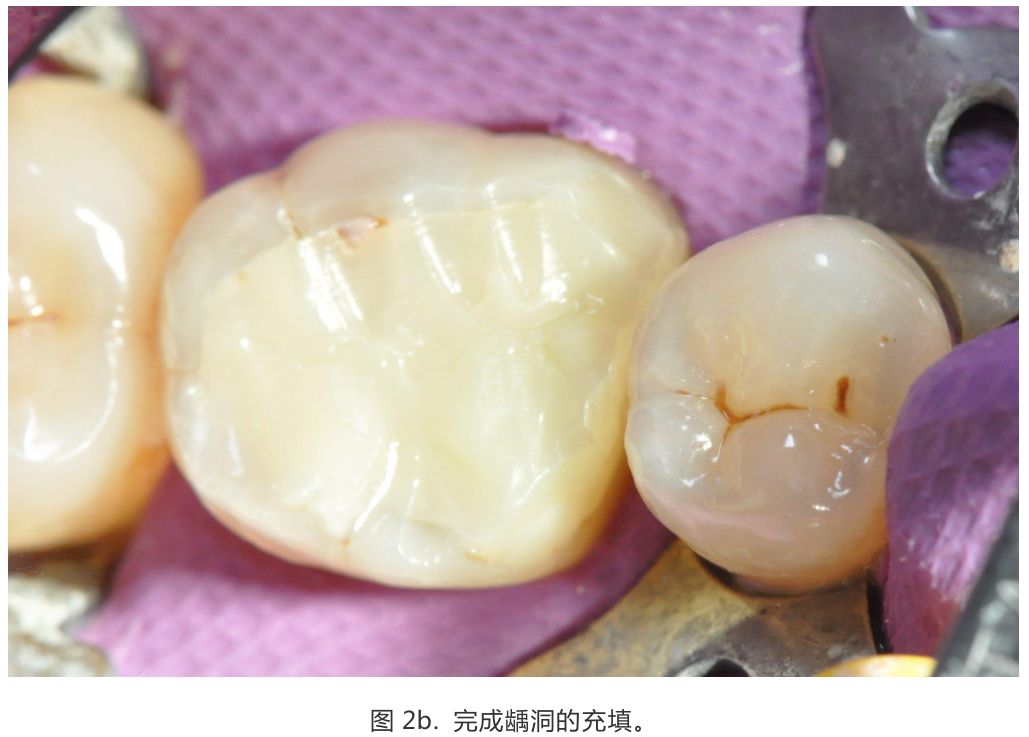 【病例分享】龈壁抬升的研究