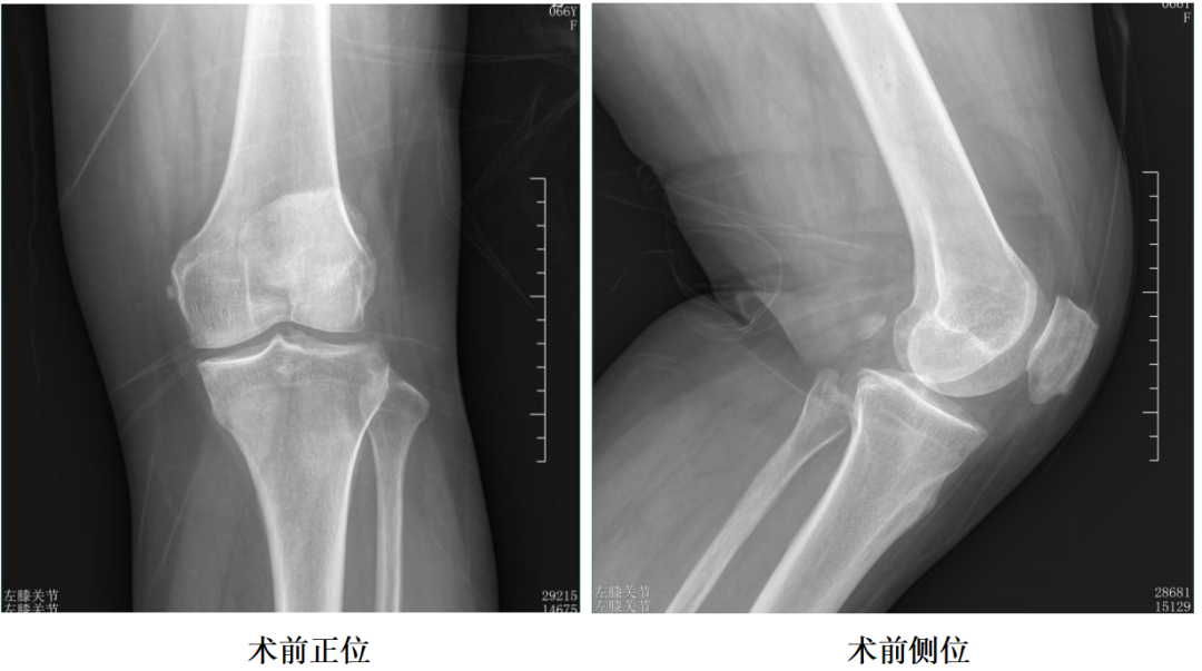 【手术视频】第五期:动力对线+非髓腔依赖滑动平台单髁置换术