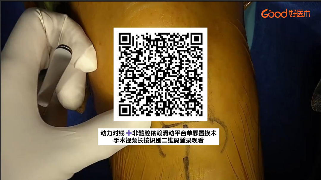 【手术视频】第五期:动力对线+非髓腔依赖滑动平台单髁置换术