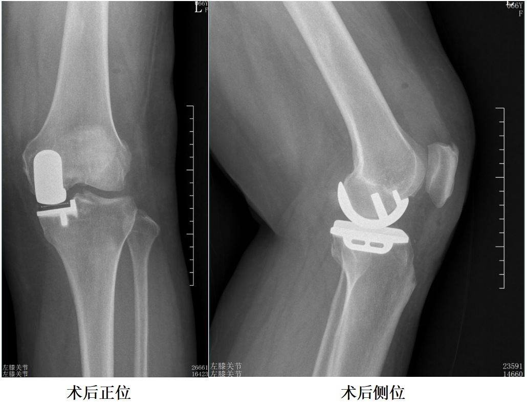 【手术视频】第五期:动力对线+非髓腔依赖滑动平台单髁置换术
