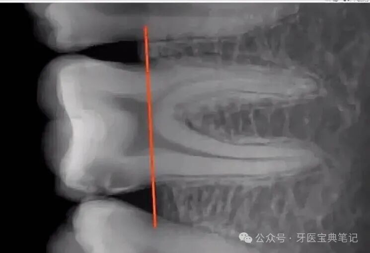 为啥你做的根管预备后疼痛?原因和预防!