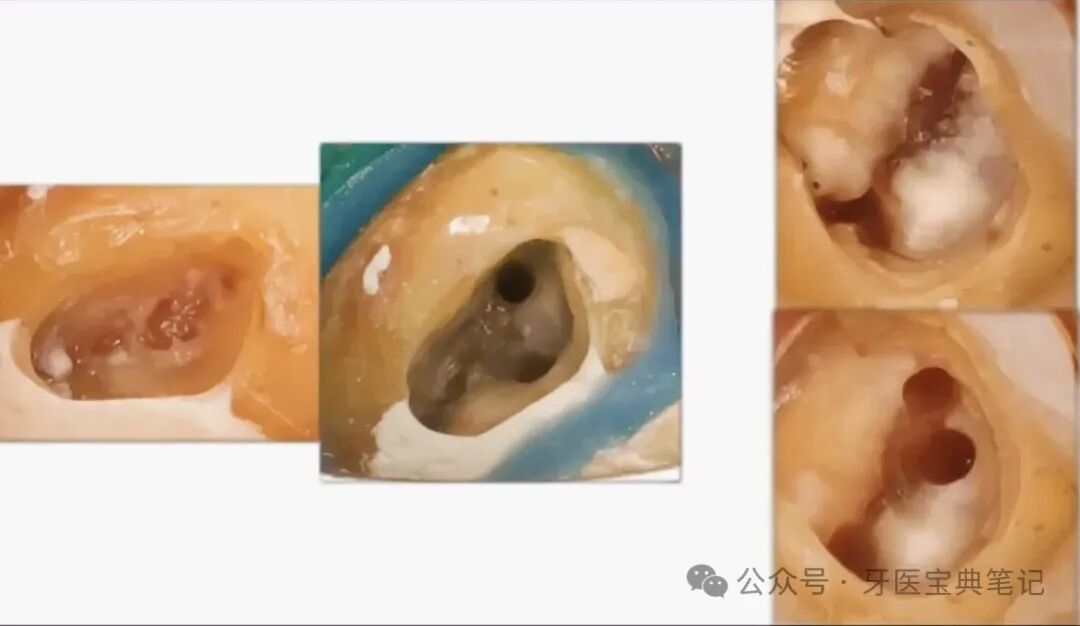 为啥你做的根管预备后疼痛?原因和预防!