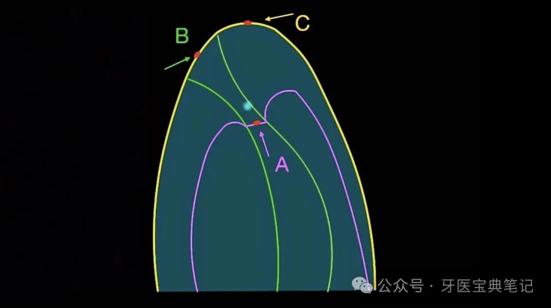 为啥你做的根管预备后疼痛?原因和预防!
