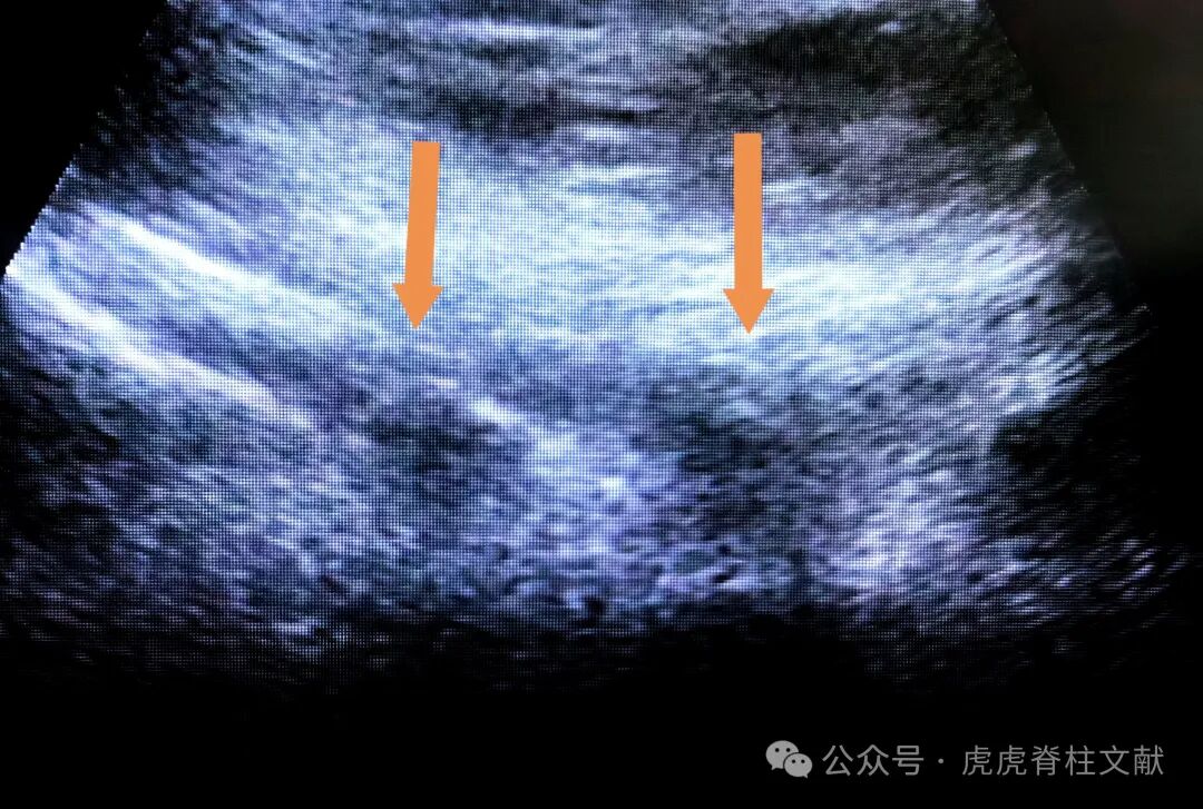 超声引导下腰5骶1椎间孔穿刺法示意图(斜短轴平面内穿刺法)