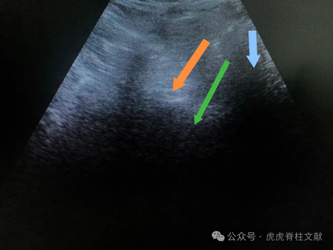 超声引导下腰5骶1椎间孔穿刺法示意图(斜短轴平面内穿刺法)