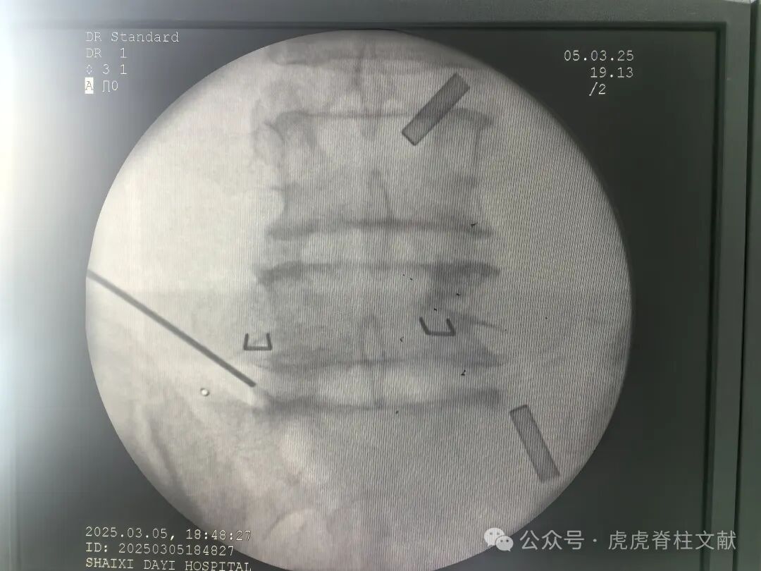 超声引导下腰5骶1椎间孔穿刺法示意图(斜短轴平面内穿刺法)