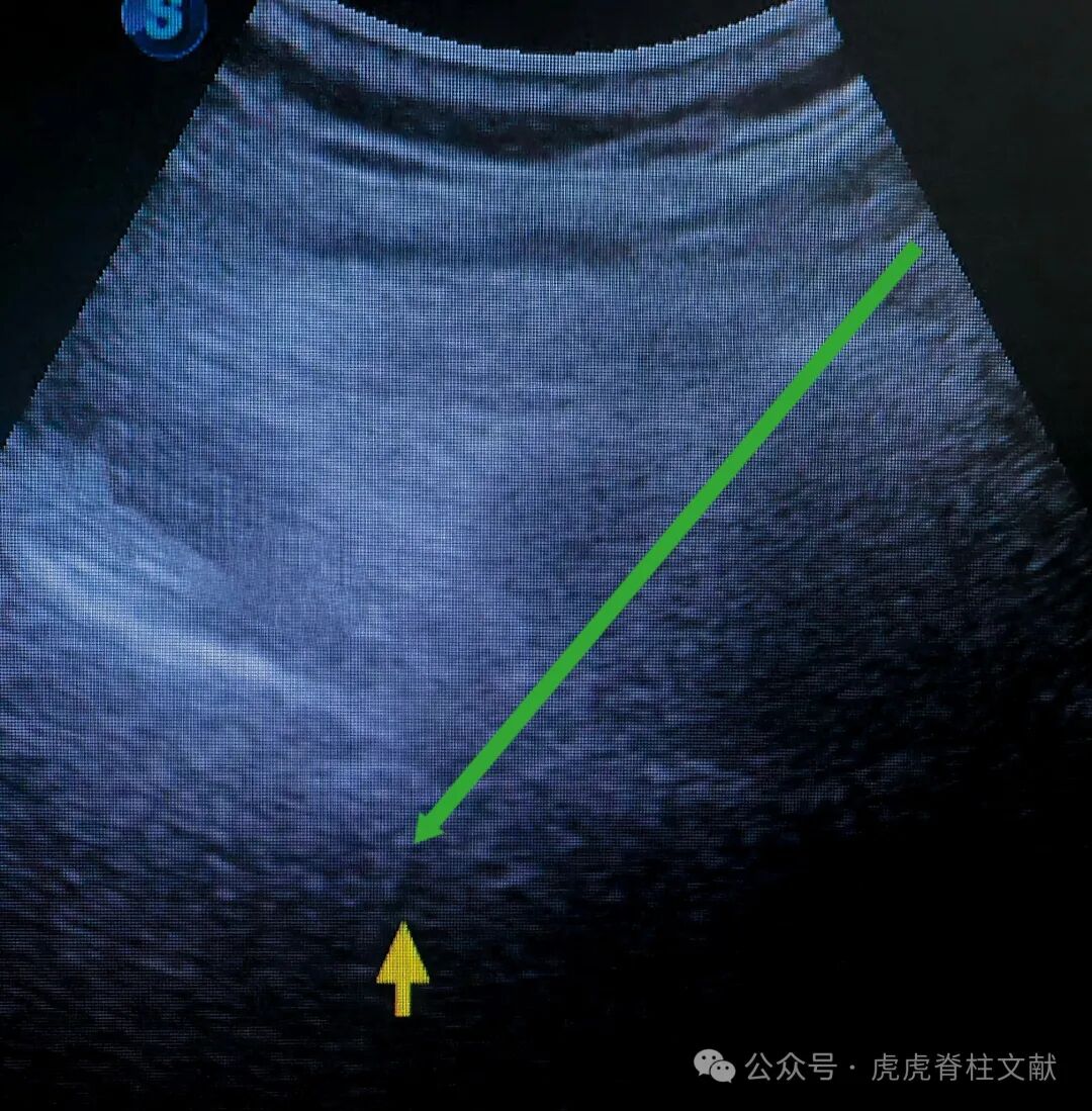 超声引导下腰5骶1椎间孔穿刺法示意图(斜短轴平面内穿刺法)