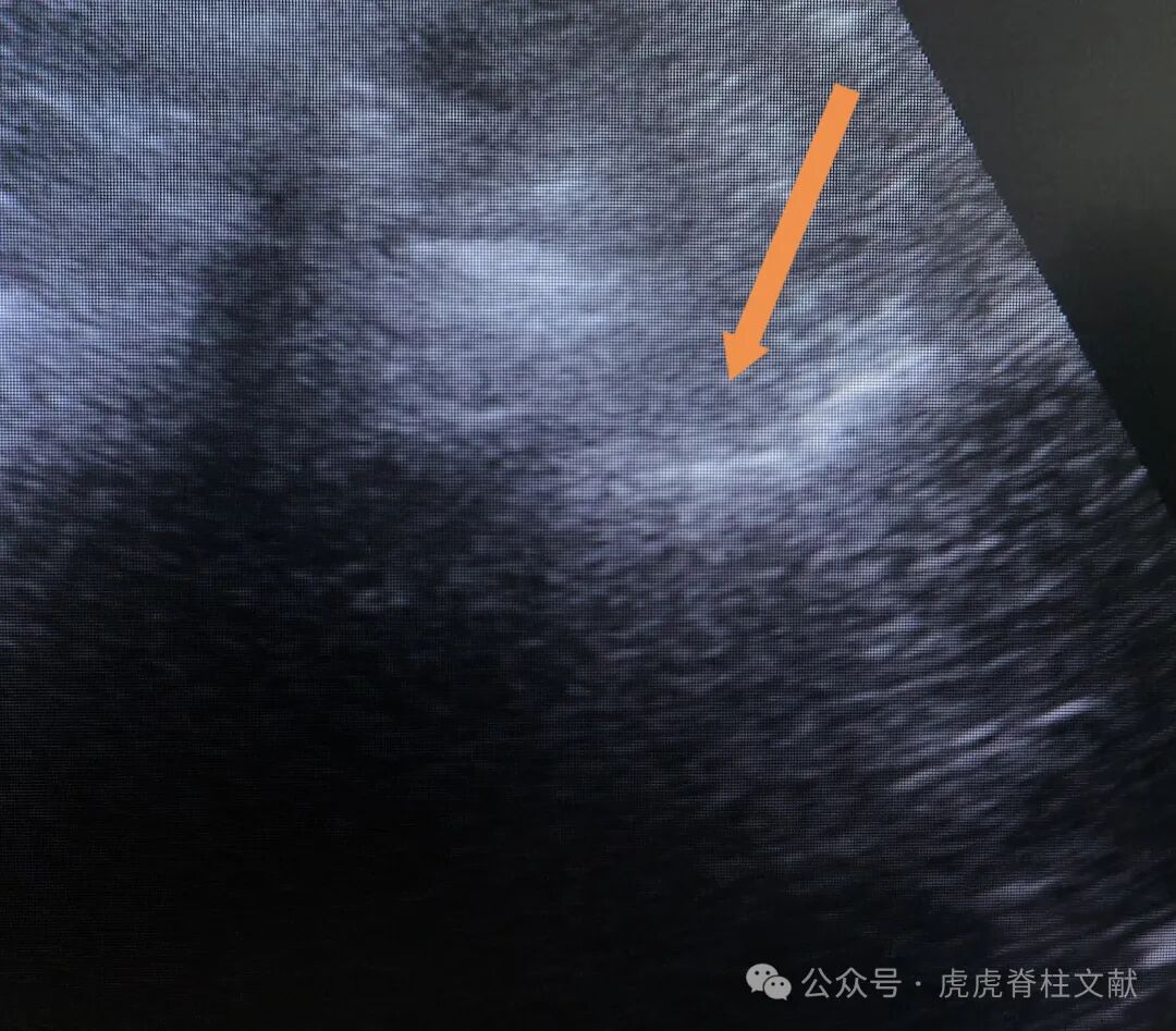 超声引导下腰5骶1椎间孔穿刺法示意图(斜短轴平面内穿刺法)