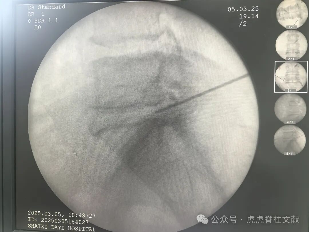 超声引导下腰5骶1椎间孔穿刺法示意图(斜短轴平面内穿刺法)