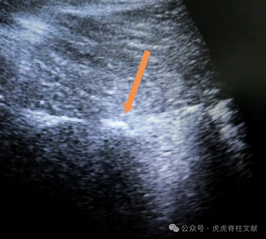 超声引导下腰5骶1椎间孔穿刺法示意图(斜短轴平面内穿刺法)