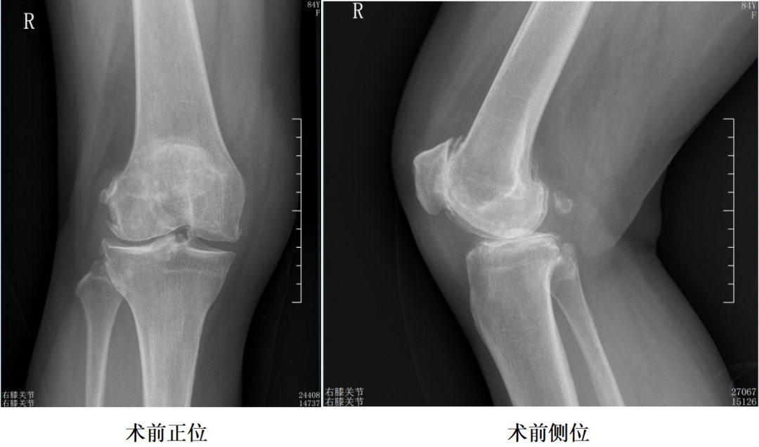 【手术视频】第六期:外侧固定平台单髁置换术(link假体)