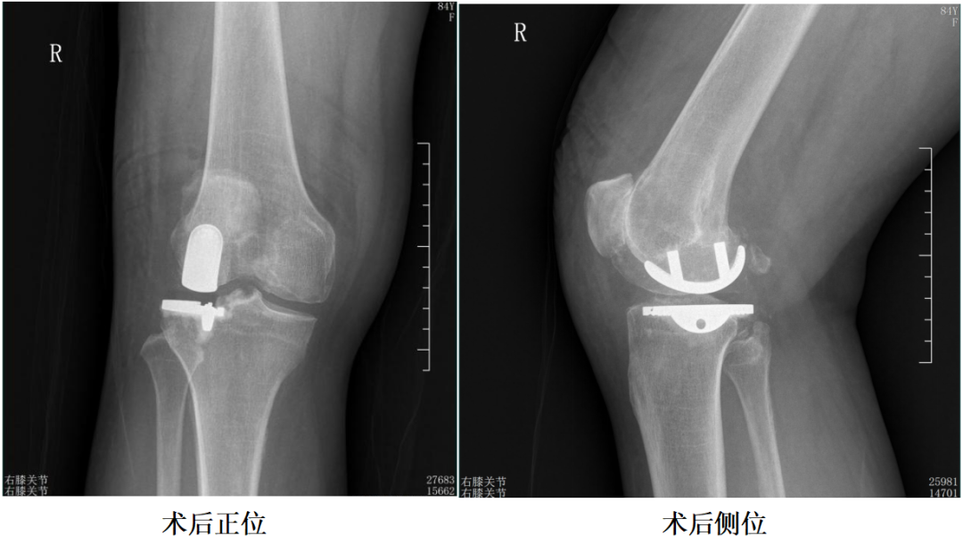 【手术视频】第六期:外侧固定平台单髁置换术(link假体)