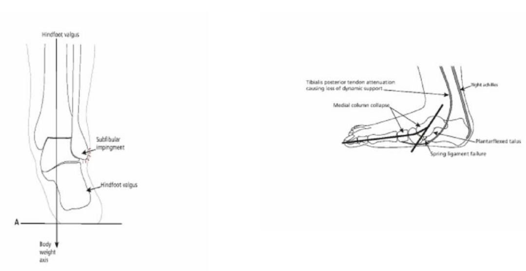 【足踝教程】进行性塌陷足畸形（英国经验）