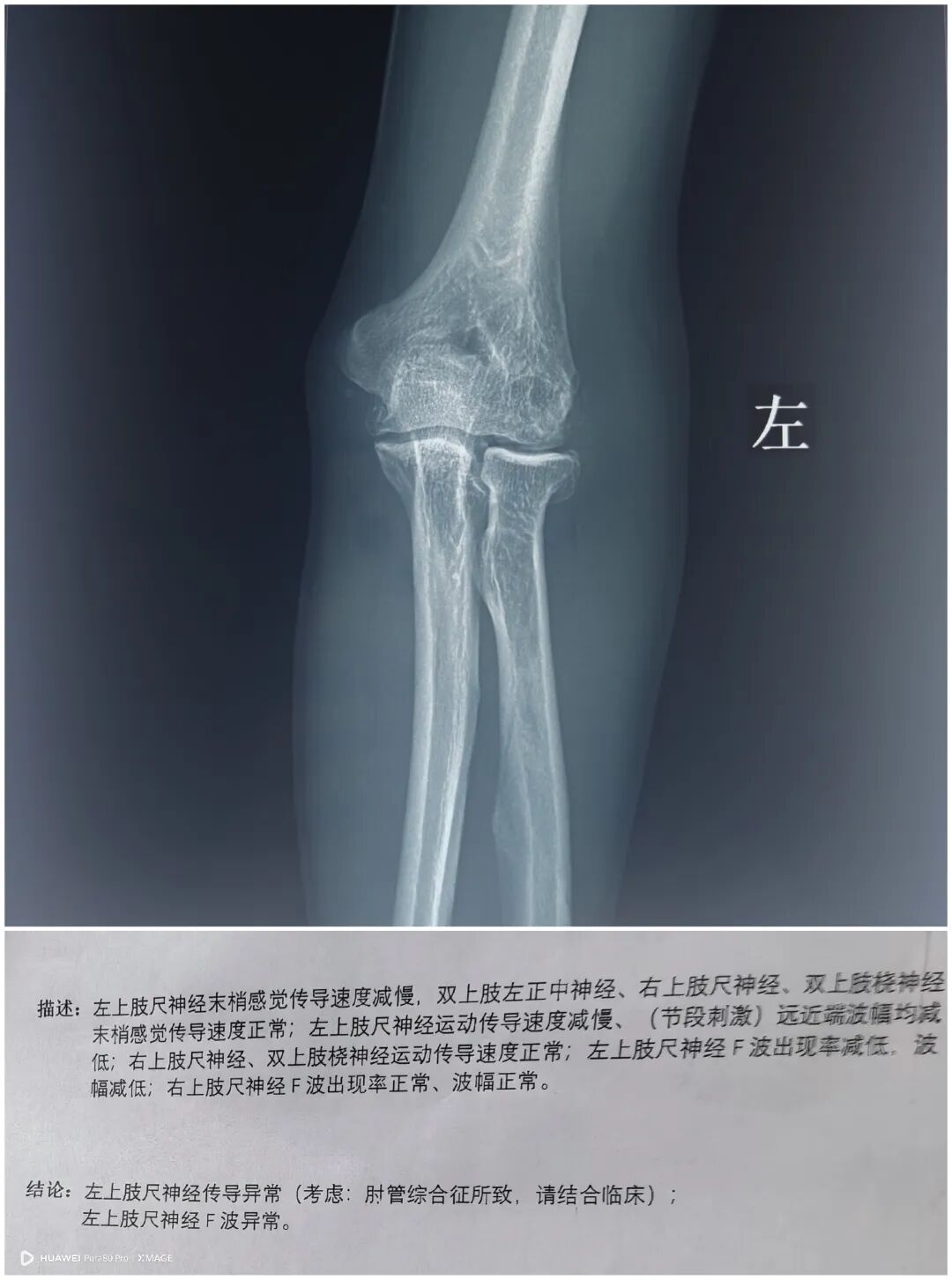 肘管综合征，尺神经前置术