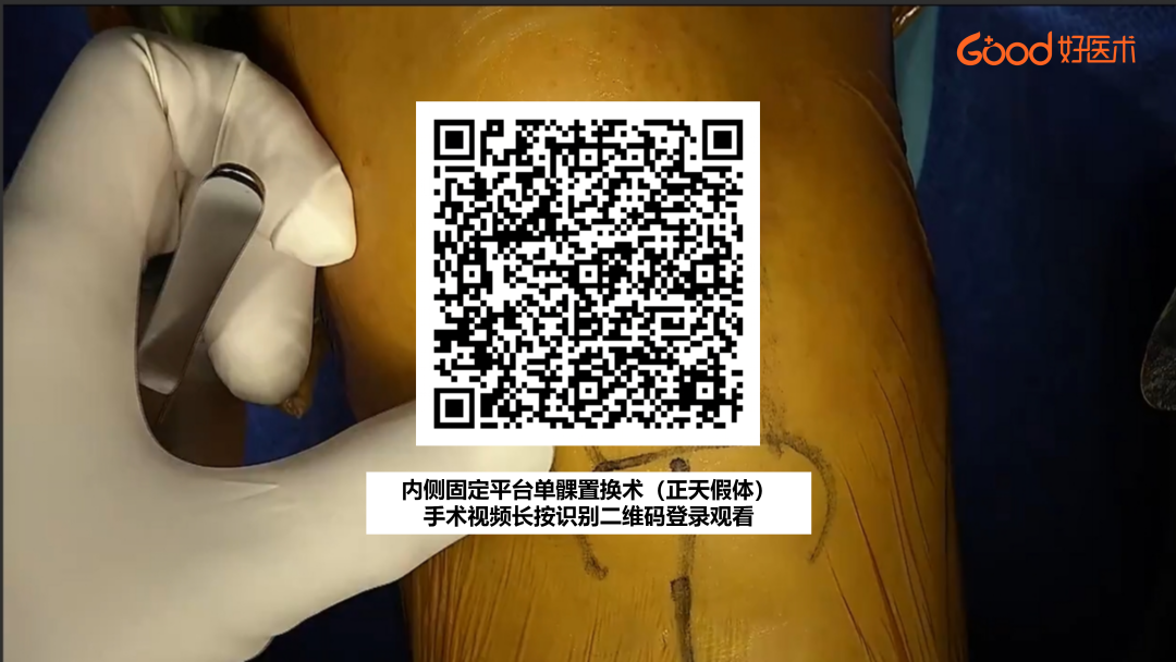 【手术视频】第七期:内侧固定平台单髁置换术(正天假体)