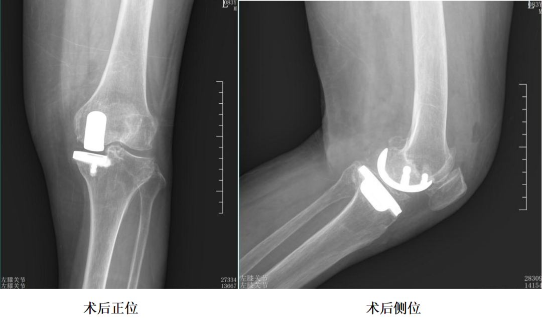 【手术视频】第七期:内侧固定平台单髁置换术(正天假体)