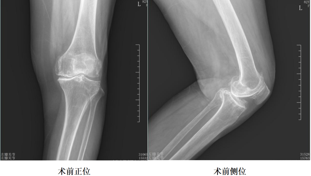 【手术视频】第七期:内侧固定平台单髁置换术(正天假体)