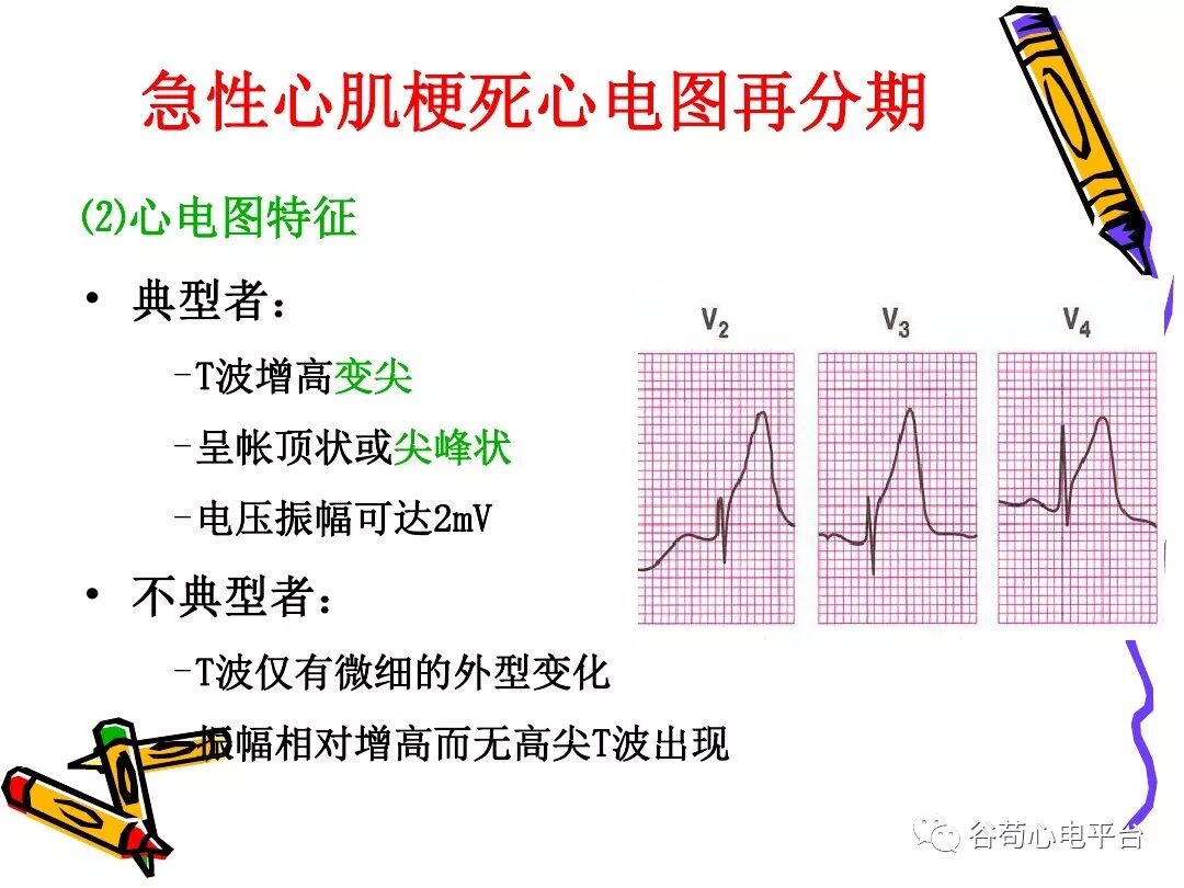 急性心肌梗死新定义（全球统一定义）