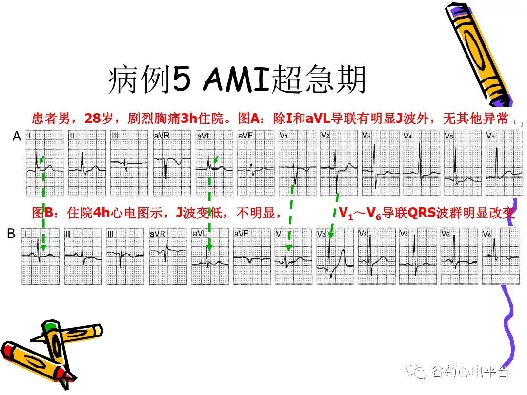 急性心肌梗死新定义（全球统一定义）