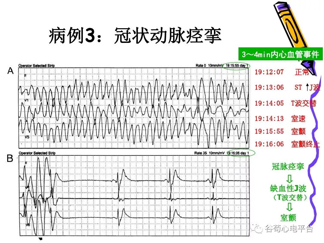 急性心肌梗死新定义（全球统一定义）