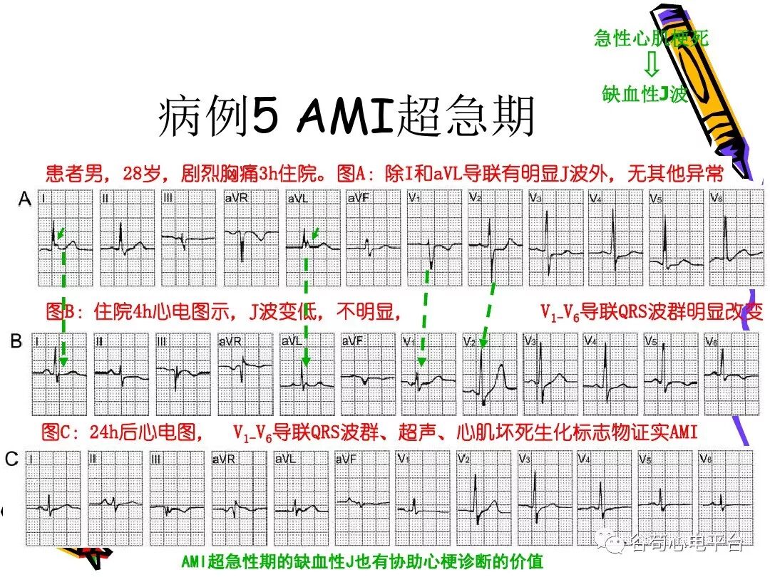 急性心肌梗死新定义（全球统一定义）