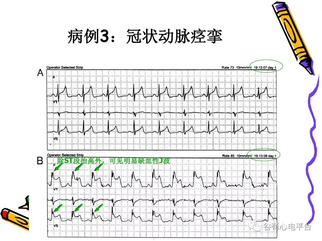 急性心肌梗死新定义（全球统一定义）
